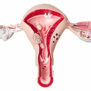endometriosis getting pregnant