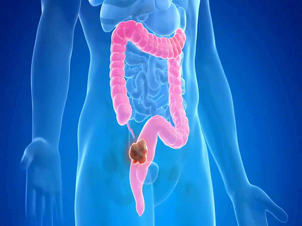 endometriosis rectum